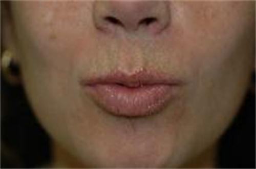 Fillers 2 prima